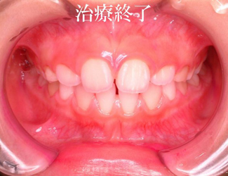 治療終了
