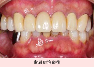 歯周病治療後