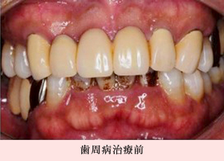歯周病治療前