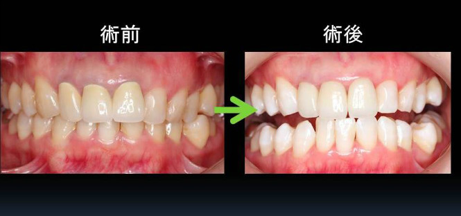 ホワイトニングの治療例
