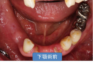 歯周病治療前