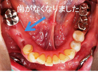 歯周病治療前