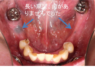 歯周病治療前