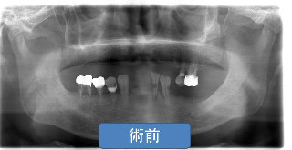 歯周病治療前