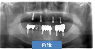 歯周病治療後