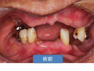 歯周病治療前