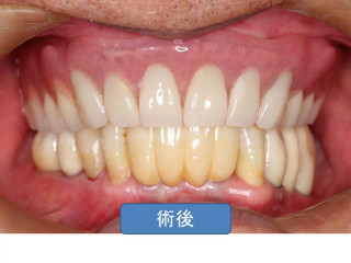 歯周病治療後