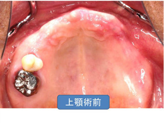 歯周病治療前