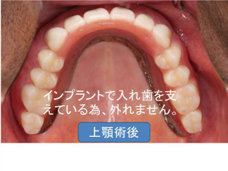歯周病治療後