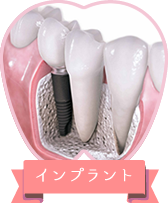インプラント