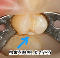 虫歯を除去したところ