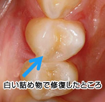 白い詰め物で修復したところ