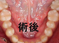 術後