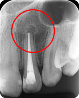 歯根端切除術（重度の虫歯）