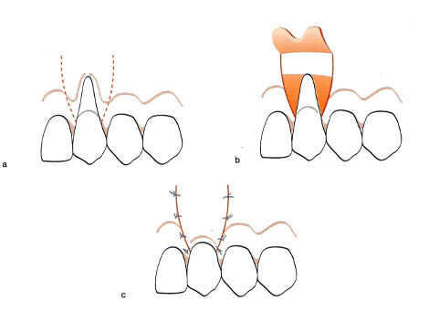 歯肉弁歯冠側伸展法