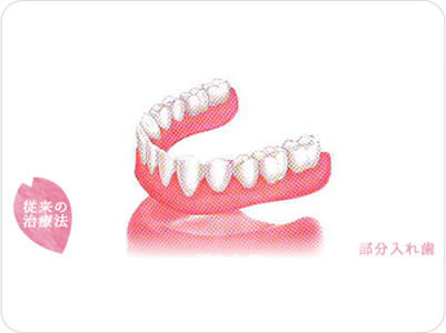 従来の治療法　部分入れ歯