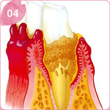 重度の歯周病（歯肉炎）