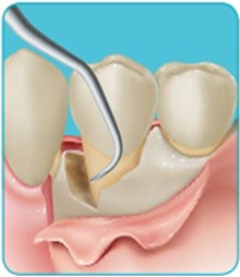 04.歯肉の剥離 ・歯根表面の清掃